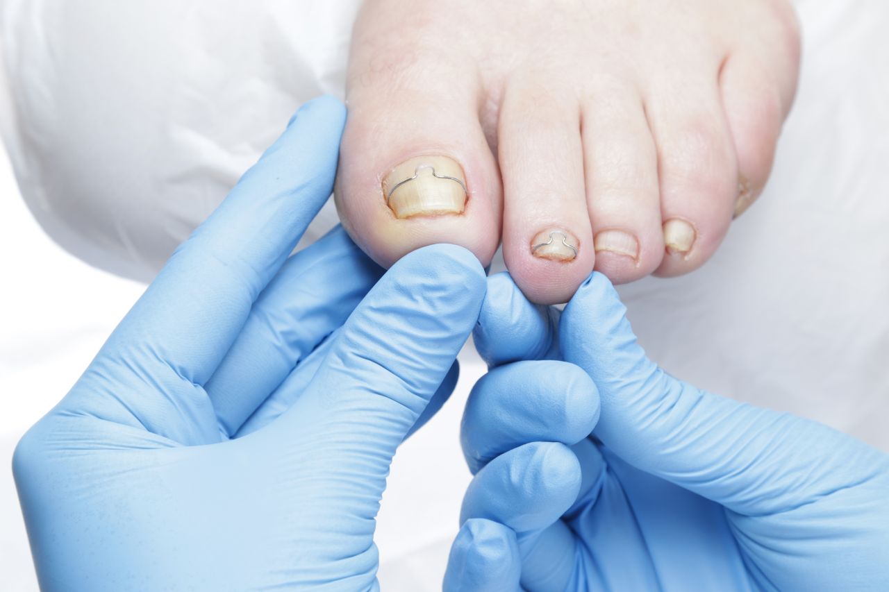 Jak podolog może pomóc w prawidłowej pielęgnacji paznokci?