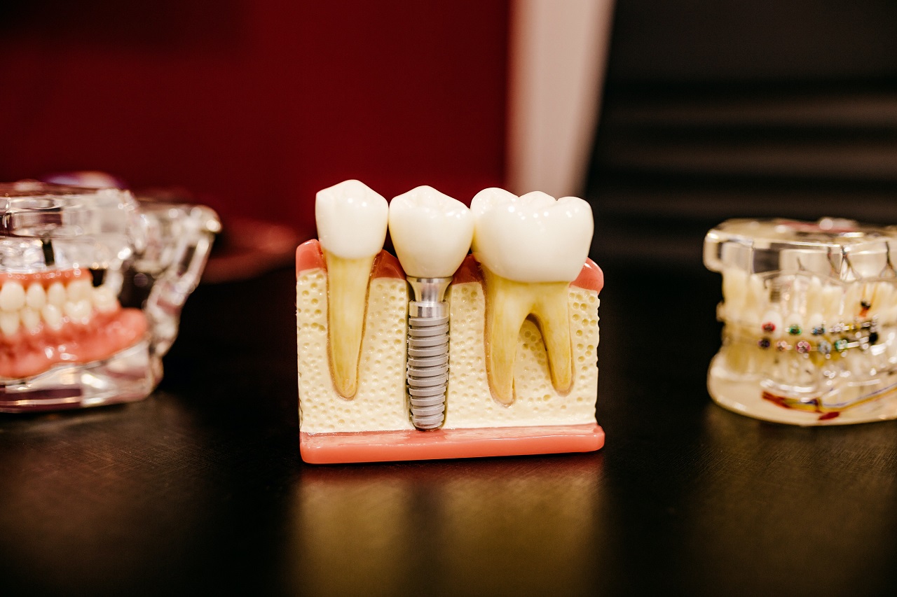 Implanty zębów – kiedy się na nie zdecydować?